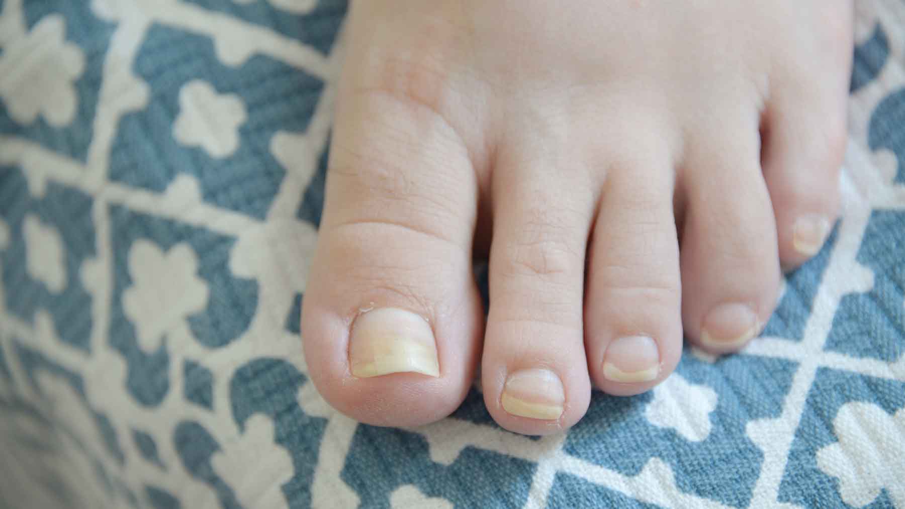 What can you do about yellow nails? | Ohio State Medical Center What can you do about yellow nails? | Ohio State Medical Center