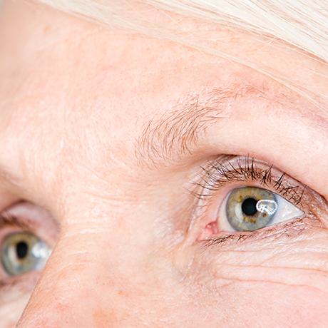 glaucoma