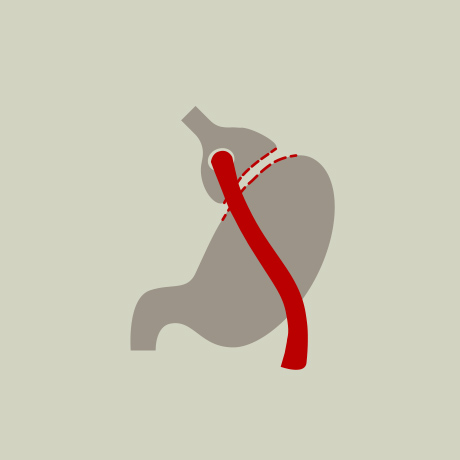 Gastricbypass